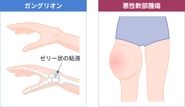 悪性軟部腫瘍 軟部肉腫 | 希少がんセンター
